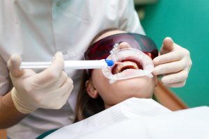Sbiancamento Dentale a Verona: Ottieni un Sorriso Radioso con gli Studi Dentistici Montagna